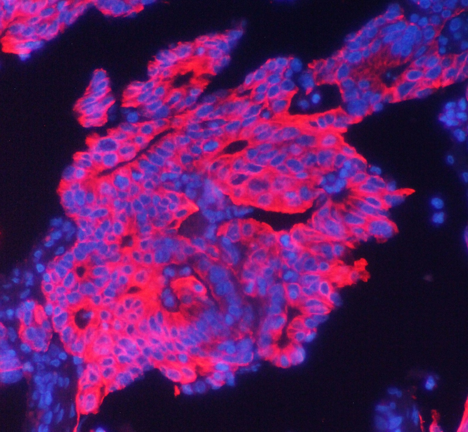 图1. 使用Anti-KRT19抗体（M02101-2）在肠癌组织石蜡包埋切片中检测的IF分析。 组织切片使用 DyLight 550 Conjugated AffiniPure Goat Anti-mouse IgG (H+L) 二抗（红色）（目录#BA1133）染色，并用 DAPI（蓝色）复染。