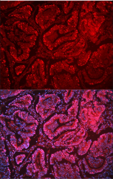 图 1. 使用 Anti-PCNA 抗体（BM0104）在人结直肠癌组织石蜡包埋切片中检测到的 IF 分析。 组织切片使用 DyLight 594 Conjugated AffiniPure Goat Anti-mouse IgG (H+L) 二抗（红色）（目录#BA1141）染色，并用 DAPI（蓝色）复染。