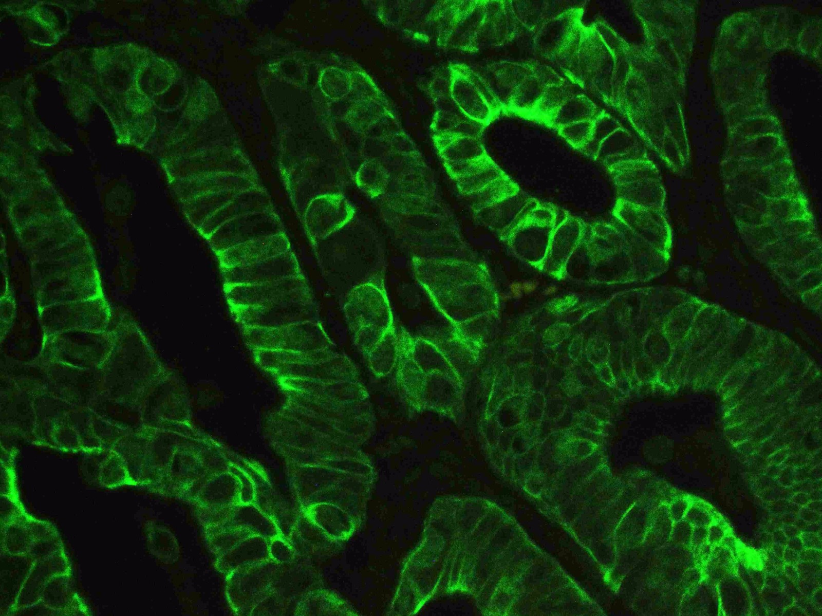 图1.使用Anti-PCK抗体(BM0034)在人肠癌组织石蜡包埋切片中检测到的IF分析。 组织切片使用 FITC 偶联蛋白 A 二抗（绿色）（目录号？#？BA1120）染色，并用 DAPI（蓝色）复染。